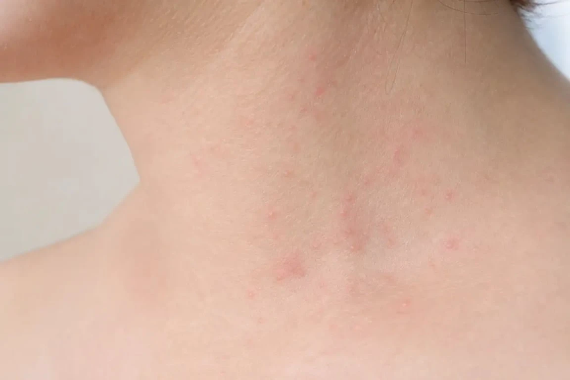 Photo de bouton de chaleur avec petits boutons rouges groupés sur la peau après transpiration